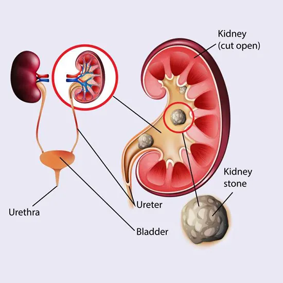 kidney stone formation diagnostic panel test